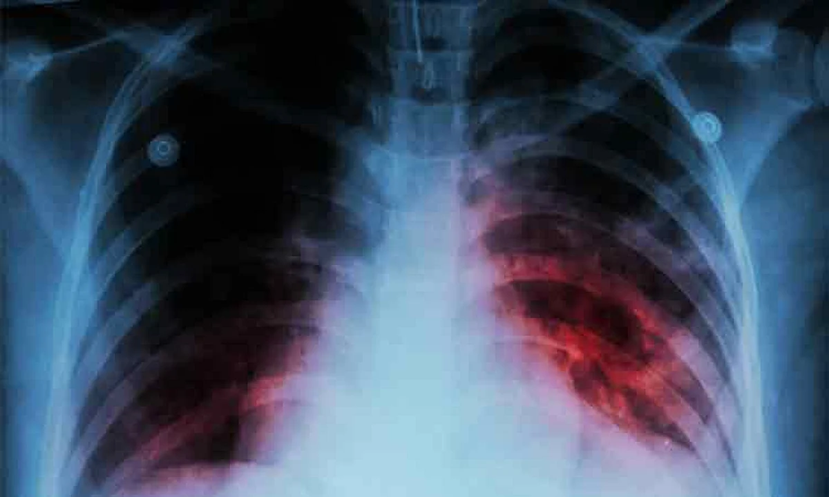 Image d'illustration pour: Youth involvement crucial in fight vs TB