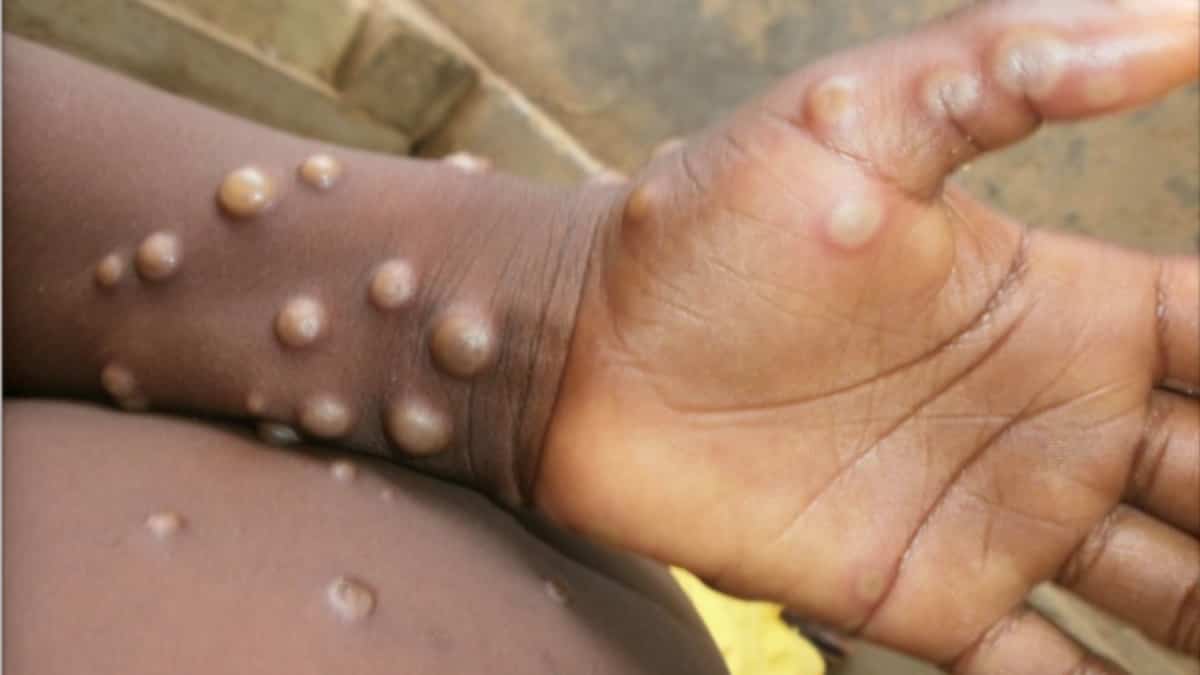Image d'illustration pour: L'OMS lève l'alerte rouge sur le mpox
