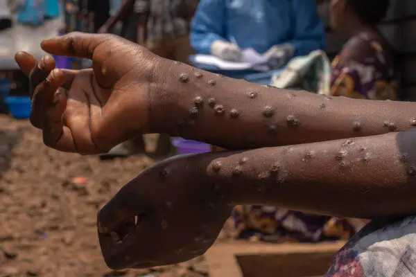 Image d'illustration pour: Ghana confirms 27 new Mpox cases, total infections hit 494